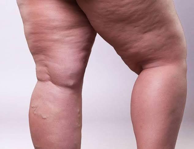 Acúmulo anormal de gordura em algumas áreas do corpo pode ser