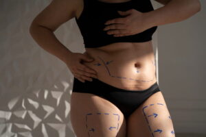 Close em marcações corporais para cirurgia plástica