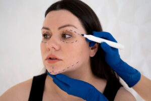 Cirurgião plástico realizando marcações faciais em paciente jovem