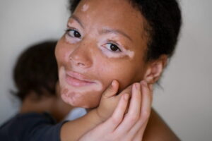 mulher com vitiligo