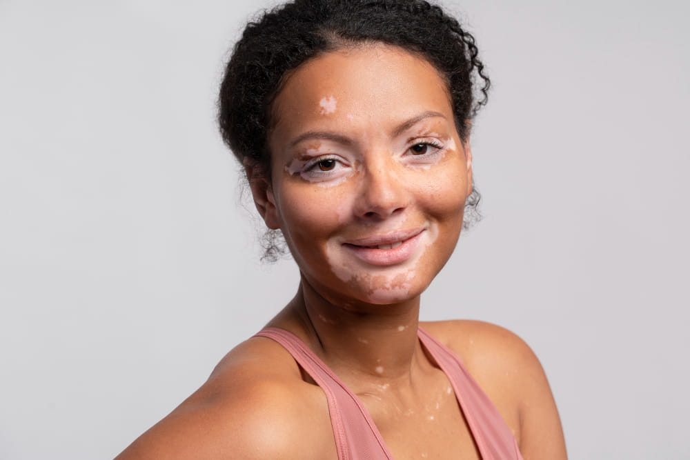 mulher com vitiligo