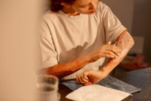 Mulher coçando o braço com vermelhidão causada por dermatite.