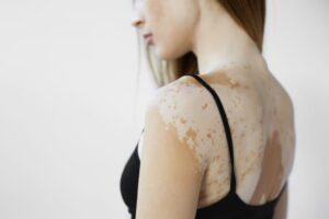 vitiligo