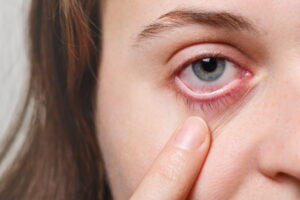 olhos irritados