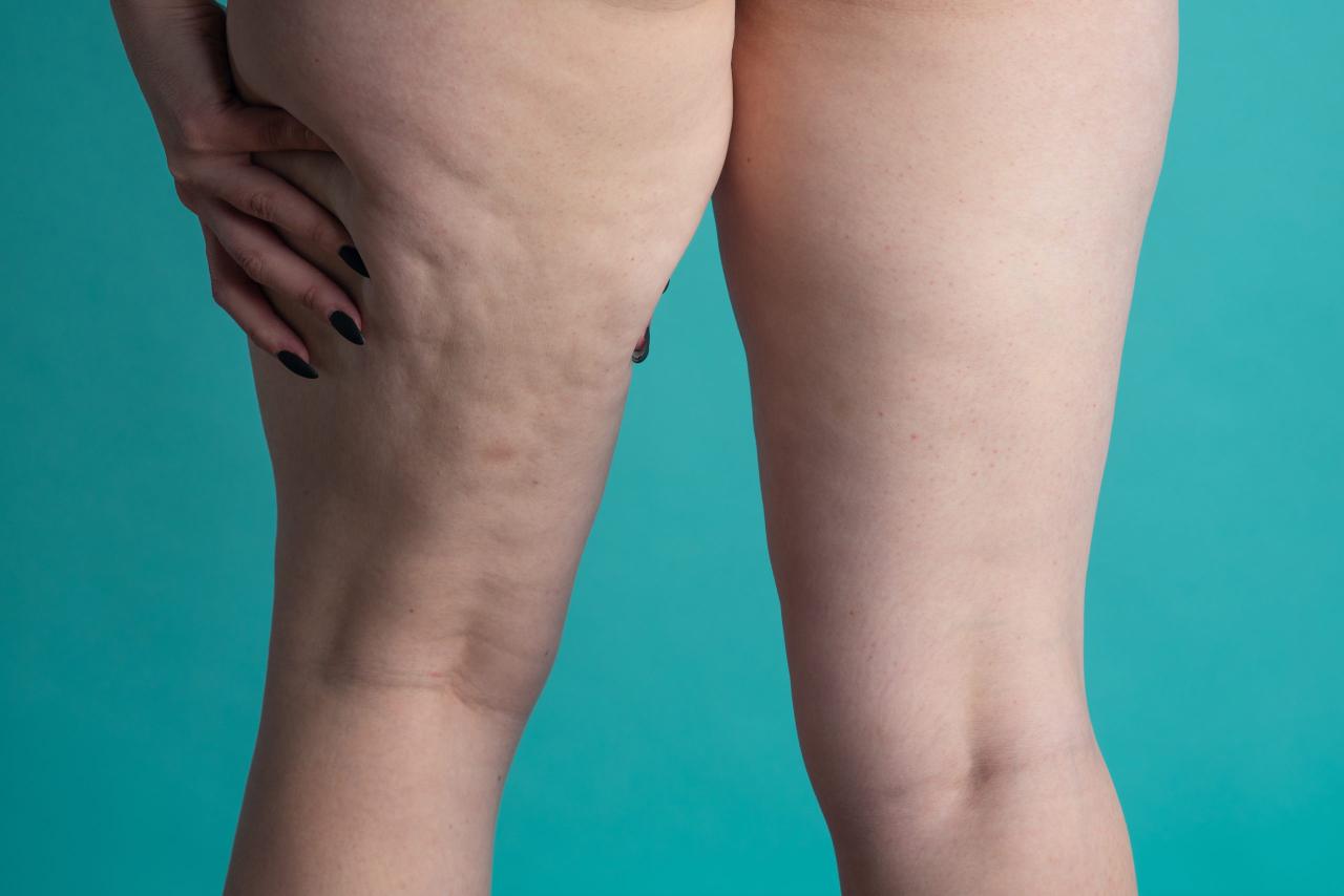 lipedema